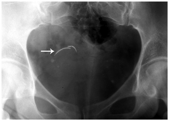X-ray showing a retained surgical needle in a patient, indicated by an arrow